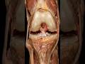 Cushioning Bone-on-Bone Friction With Targeted Knee Gel#KneeArthritis #PainManagement #newyork