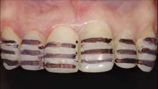 Керамические виниры. Porcelain veneers. Emax. Carillas Dentales. 牙齿镶(При подготовке зубов под керамические виниры препарирование практически не проводилось. Был иссечён высту..., 2015-09-28T05:44:35.000Z)