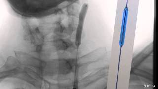 Interventional Stroke Rounds - Warning Strokes