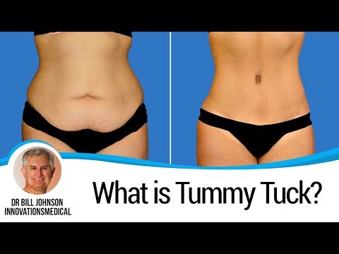 Awake Tummy Tuck Amazing Before & After Results (6 Months Post) 