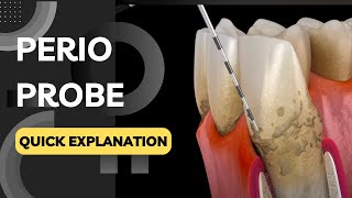 What is a Periodontal Probe Used For? Quickly Explained in a Few Seconds!