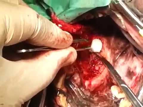 Video: Cancro Alla Bocca (fibrosarcoma Della Gengiva) Nei Cani