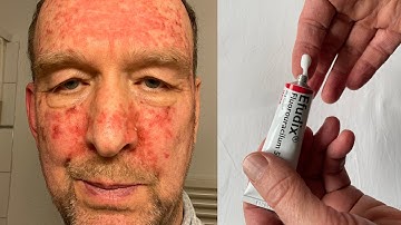 Efudix 5% Hautkrebs-Vorsorge mit Fluorouracil, Diashow 1 Minute - 50 Tage