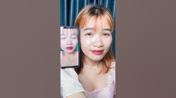 Kết quả tiêm Filler cằm trước và sau sẽ như thế nào