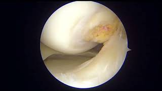 REPARACIÓN DE ROTURA DE MENISCO COMPLEJA (Medial Meniscus vertical circunferential tear)