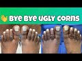 UNSIGHTLY CORN REMOVAL PROCEDURE - INTERACTIVE VIDEO WITH THE PATIENT