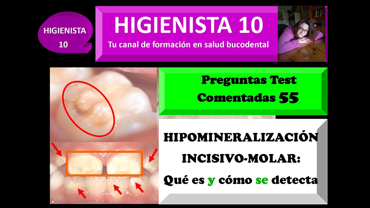 HIPOMINERALIZACIÓN INCISIVO-MOLAR: QUÉ ES Y CÓMO SE DETECTA. PREGUNTAS TEST COMENTADAS 55.