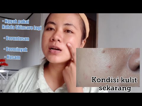 1 Bulan berhenti pakai Nahda Skincare