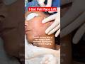 I Tried a Non-Surgical Laser Face Lift