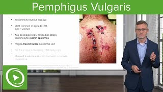 Pemphigus Vulgaris – Dermatology | Lecturio screenshot 1
