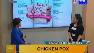 Good Morning Kuya: Chicken Pox - Symptoms and Treatment