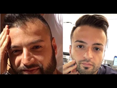 Video: Alopecia (skaldethed) Hos Mænd - Hvordan Man Stopper Skaldethed? Medicin, Shampoo