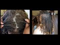WHAT&#39;S SEBORRHEIC DERMATITIS AND HOW YOU CAN GET YOUR SCALP HEALTHY