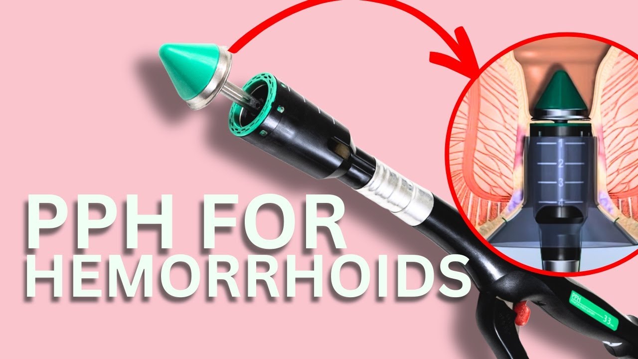 PPH Hemorrhoid Surgery Dr Chung Explains YouTube PPH Hemorrhoid Surgery Dr Chung Explains YouTube