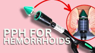 PPH hemorrhoid surgery | Dr. Chung explains