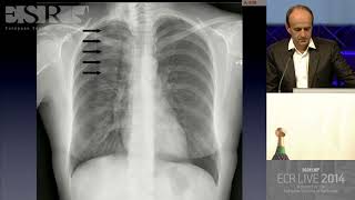 Common and Uncommon Errors in Plain Film and CT Chest - HD [Basic Radiology]
