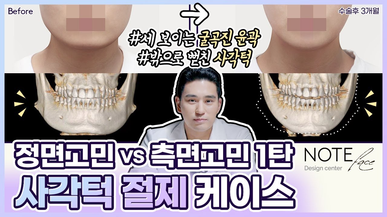 [유.케.리] 📍 CT로 보는 케이스 리뷰 l 사각턱 케이스 1탄 l 정면효과극대화 사각턱 축소 케이스