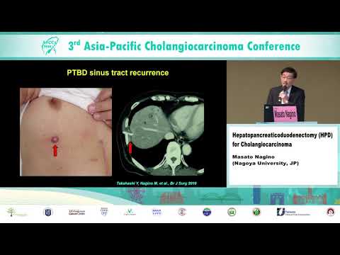 APCCA2019_012_Session 2: Hepatopancreaticoduodenectomy (HPD) for Cholangiocarcinoma