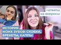 История моих зубов: скобки, брекеты, каппы + ответы на вопросы