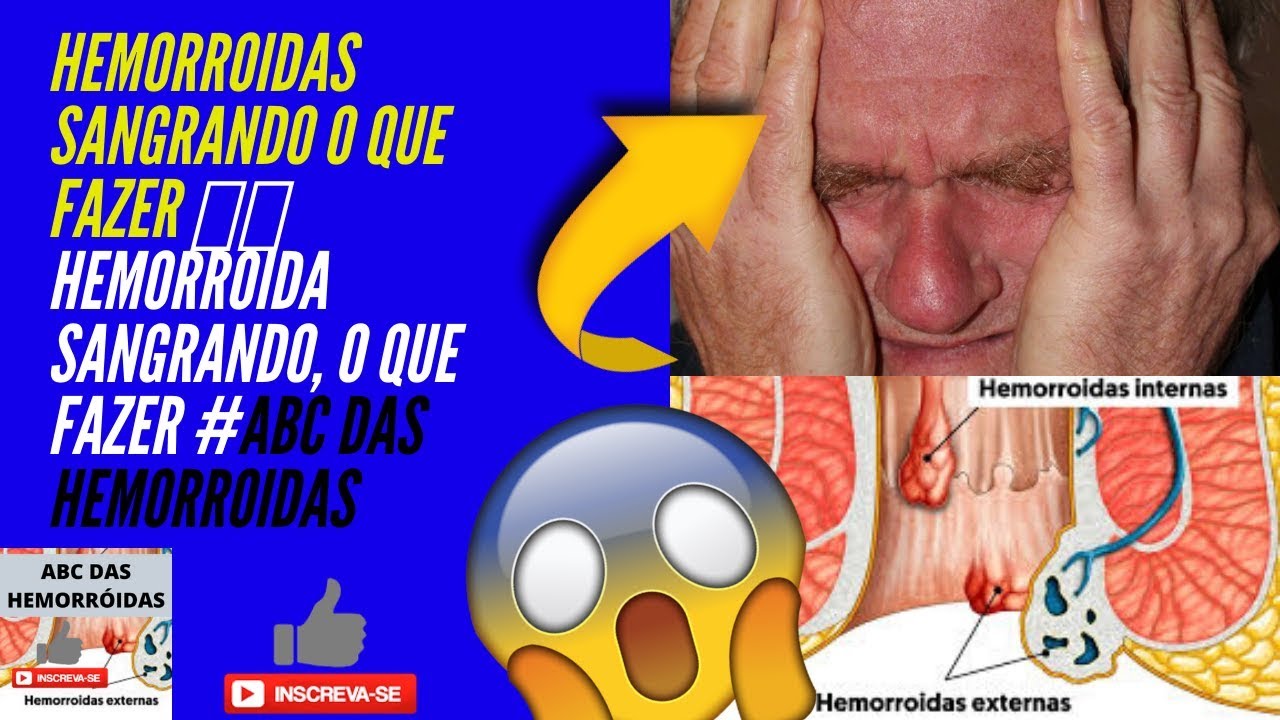 HEMORROIDAS SANGRANDO O QUE FAZER 💜💜Hemorroida sangrando, o que fazer # ...