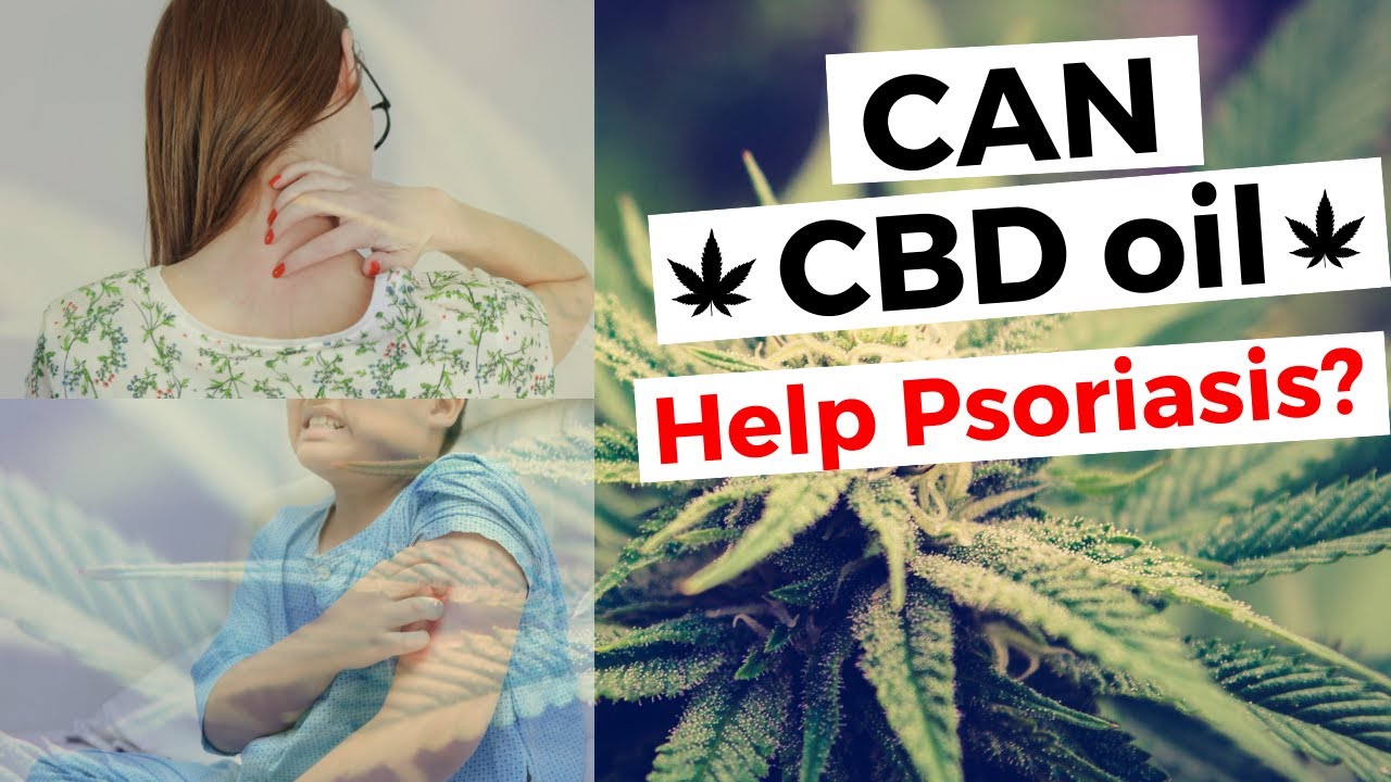 Can cbd oil help psoriasis (2019) YouTube