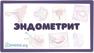 Эндометрит - симптомы, причины, лечение (гинекология) лекция