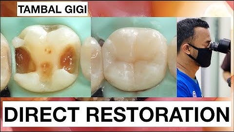 Step by step Filling Composite Lower Molar Direct Restoration Class II | General Dentist Griya RR