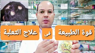 علاج الثعلبة بمكونات طبيعية مذهلة