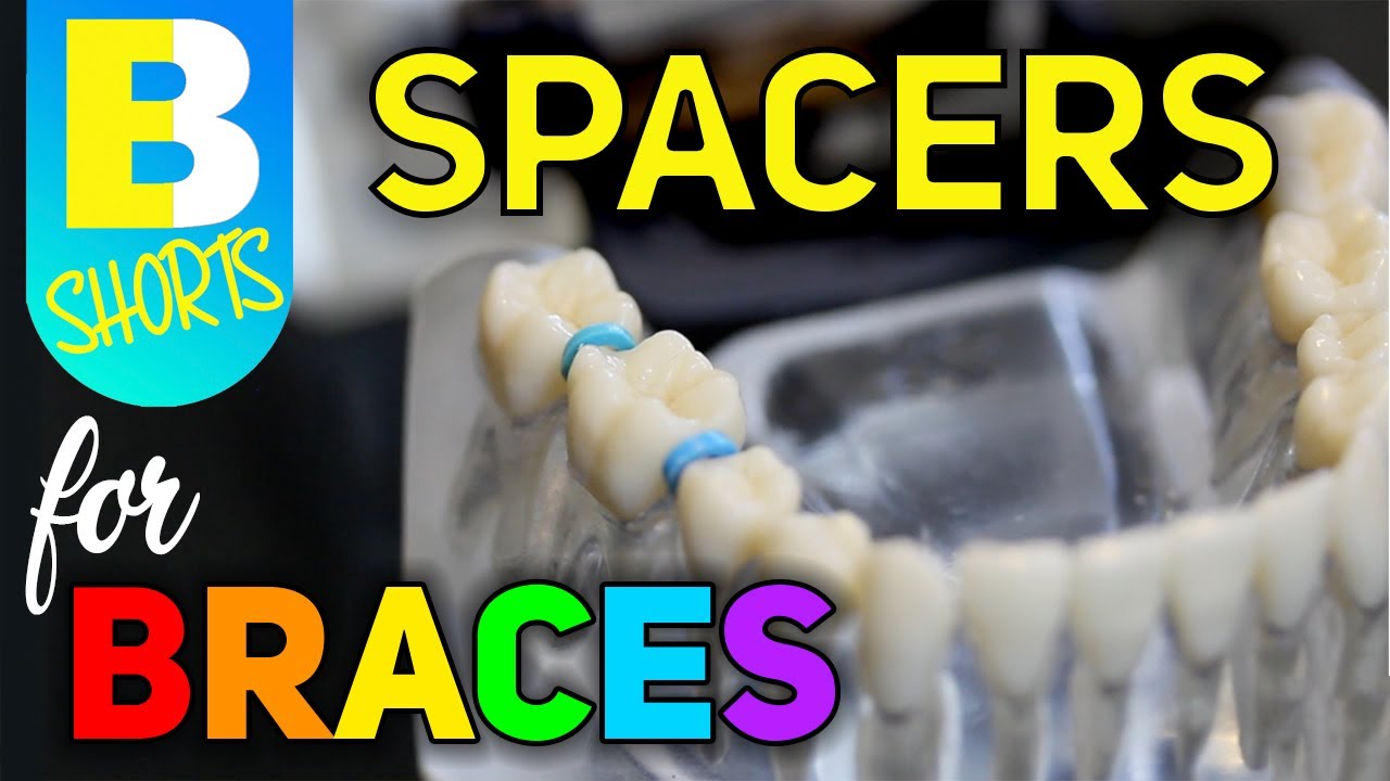 Spacers For Braces #Shorts