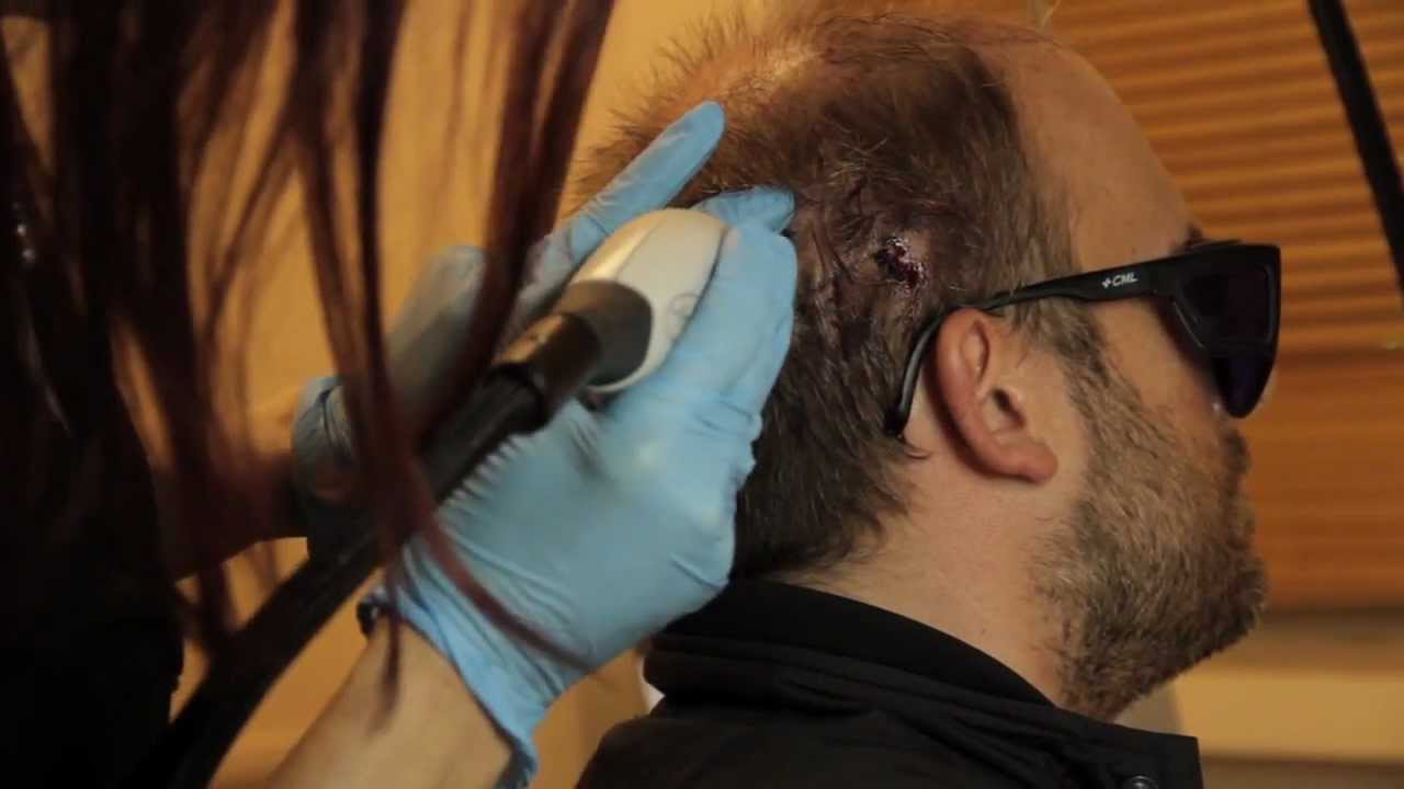 Hair Transplant YouTube