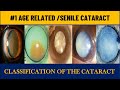 Age related cataract  senile cataract stages 