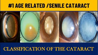 Age related Cataract | Senile cataract stages |