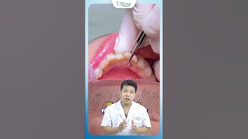 30 Năm Không Đi Lấy Cao Răng Sẽ Như Thế Nào | Nha Khoa Minh Châu