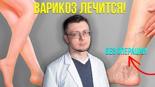Как лечить варикоз без операции? Советы хирурга