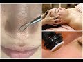 {ASMR Soft Spoken} Dehydrated Clogged Skin Facial + Microneedling for Acne Scars & Scalp Massage