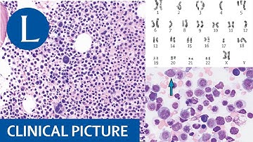 Acute myeloid leukaemia and cytogenetic and molecular abnormalities