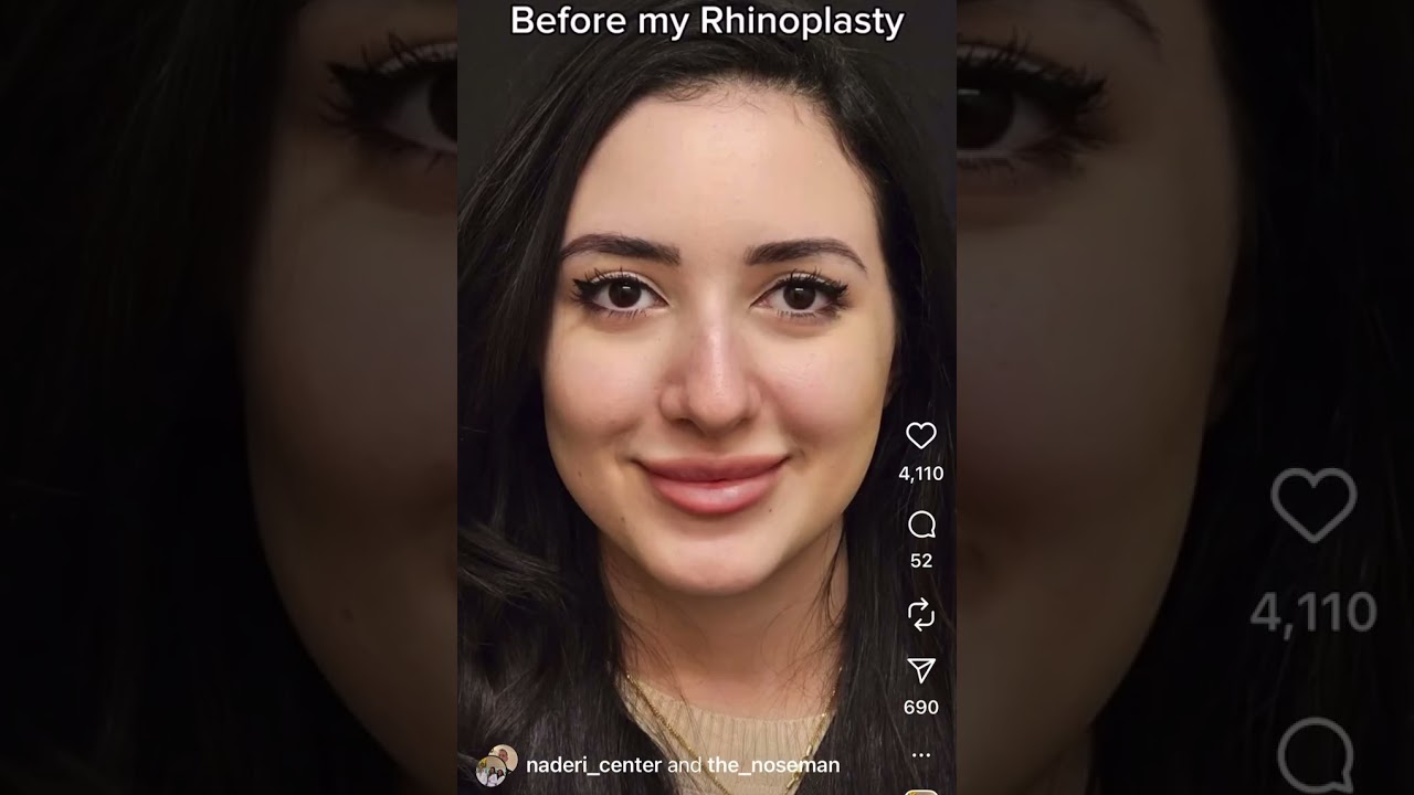 Rhinoplasty patient of Dr. Shervin Naderi, before and after video