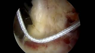 All-Arthroscopic Management Of Locked Posterior Shoulder Dislocation Reduction