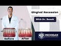 What is Gingival Recession? With Dr. Julius Bunek at Michigan Implants and Periodontics