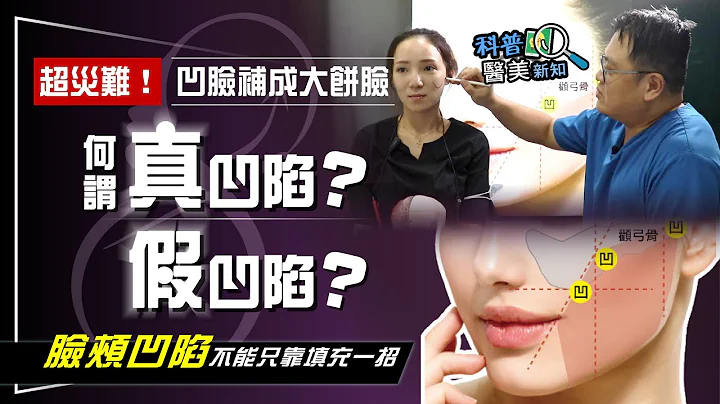 超災難！凹凹臉狂填補竟成大餅臉 何謂真凹陷、假凹陷...搞清楚了嗎？ 科普醫美新知 322-20230707 - 天天要聞