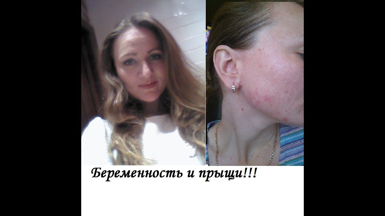 Беременность и прыщи
