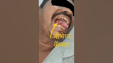 ज भ च क न सर L Tongue Cancer L Clinical Case 