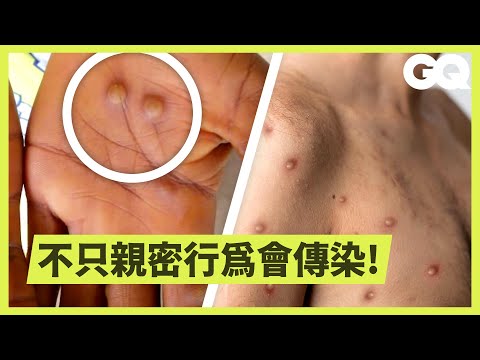 「猴痘」傳播方式、病症、如何治療一次看！天花疫苗對猴痘有效？ Epidemiologist Answers Monkeypox Questions｜科普長知識｜GQ Taiwan