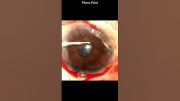 The technique of removing a fibrotic pupillary membrane in small pupil  phacoemulsification