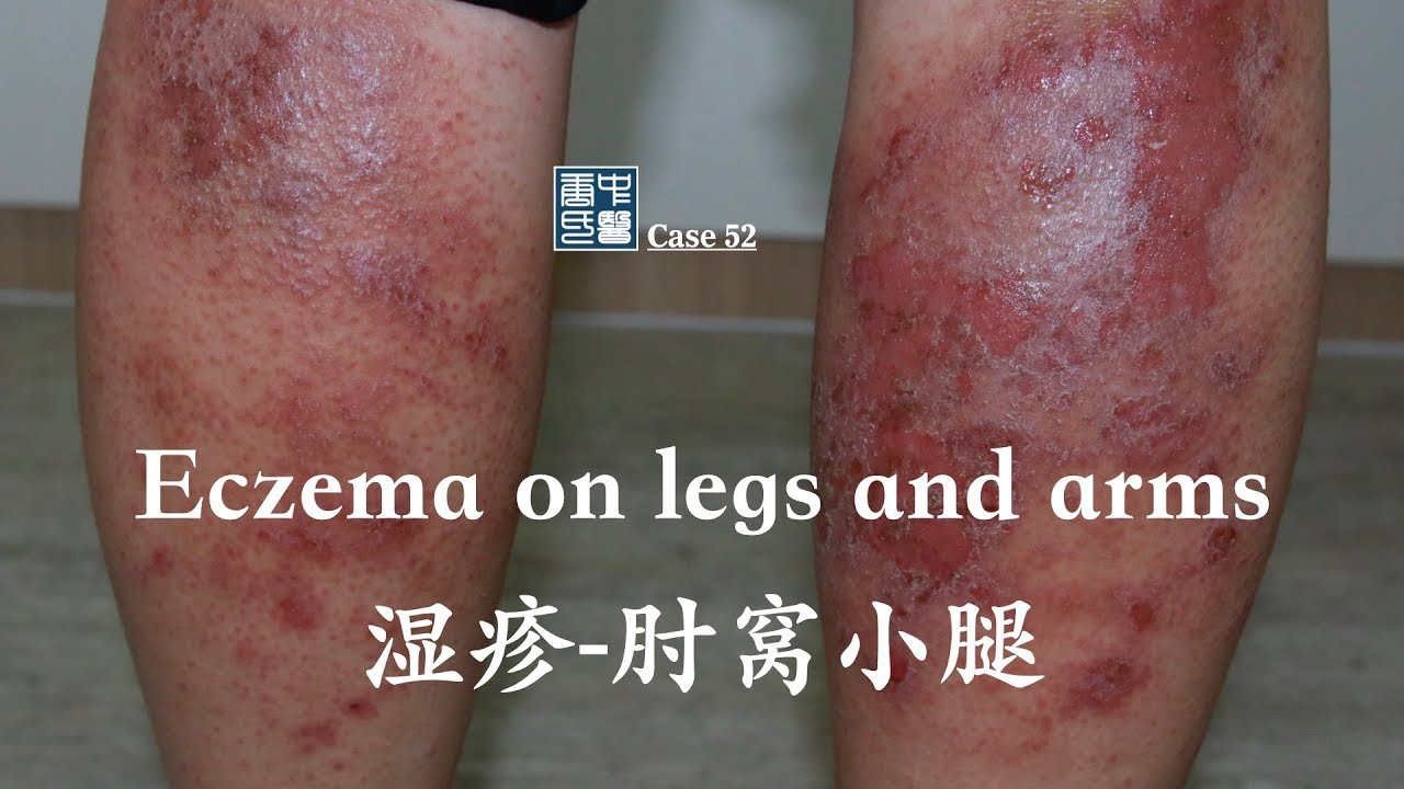Eczema on lower legs and arms 消退和肘窝湿疹 