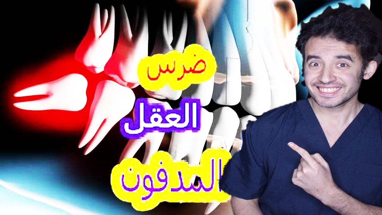 ضرس العقل المدفون