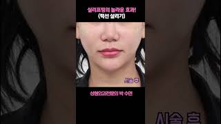 실리프팅의 놀라운 효과 (턱선 살리기)!? #실리프팅#v라인만들기#박수연원장