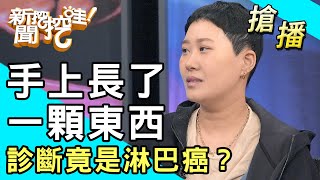 【搶播】手上長了一顆東西...診斷竟是淋巴癌？