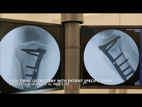 High Tibial Osteotomy for Varus Malalignment with Custom Patient Specific Guide