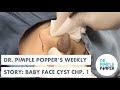 Dr. Pimple Popper's Weekly Story: Baby Face Cyst, Ch 1!